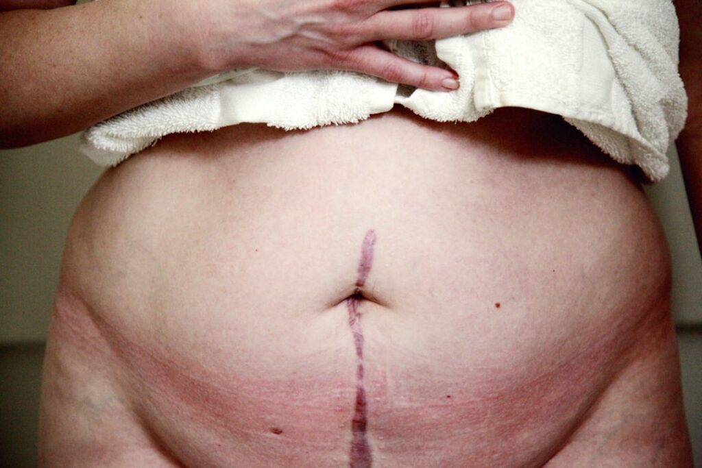 Photo Cesarean scar mobilization